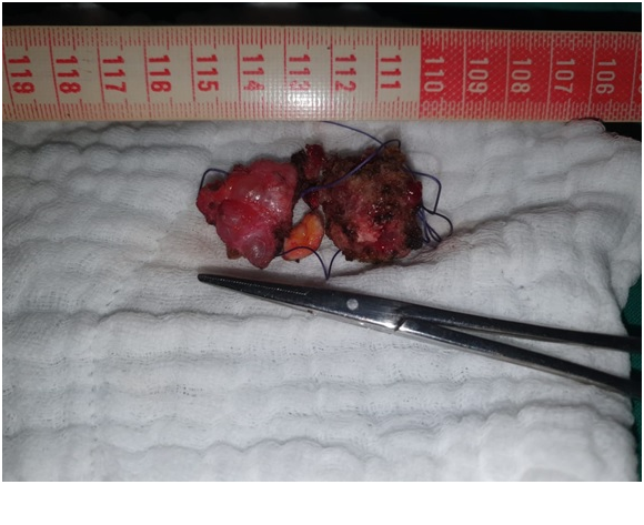 Figure 5) Pièce opératoire de  l'adénocarcinome excisé au large