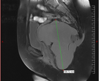 Adénocarcinome retro-rectal 7 ans post excision d’un tailgut-cyst, rapport d’un cas et propositions pour prévenir la récidive.