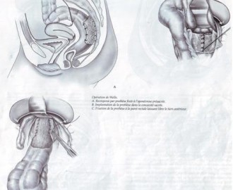 TRAITEMENTS DES RECIDIVES - PROLAPSUS TOTAL DU RECTUM A PROPOS DE 7 CA