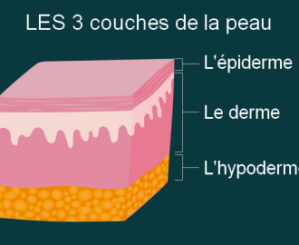 Qu'est-ce qu'une brûlure ?
